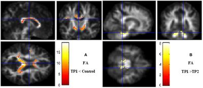 Longitudinal Effects of Bumetanide on Neuro-Cognitive Functioning in Drug-Resistant Epilepsy